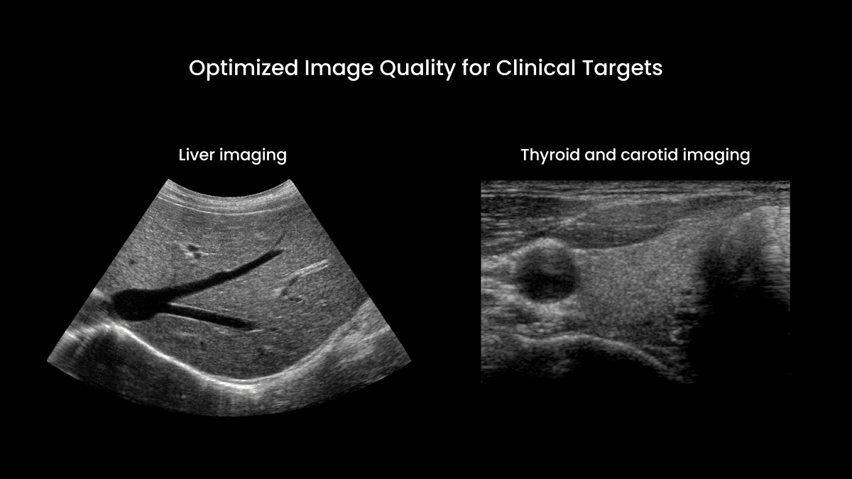 Optimized Image Quality for Clinical Targets Vantage NXT now provides acquisition sequences optimized for high image quality for a wide range of transducers. These two examples show images acquired in liver and thyroid for demonstration purposes