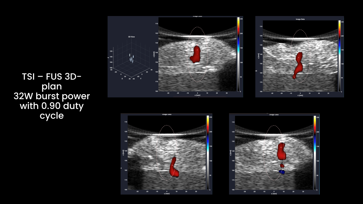 Thermal Strain Imaging (TSI) – FUS3D 3D real-time procedure using HIFU bursts at a PRF of 1Hz, 32W total acoustic burst power, with a 90% burst duty cycle in an ex vivo chicken breast tissue. Twelve different focal exposures were applied within a volume. The TSI images represent an increase in temperature (heating) during HIFU treatment at different locations.