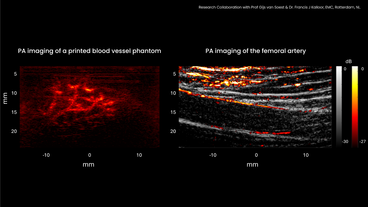 Photoacoustic Imaging Vantage NXT supports Receive-only mode fundamental for Photoacoustics (PA) imaging. It also supports interleaving of B-mode and PAI