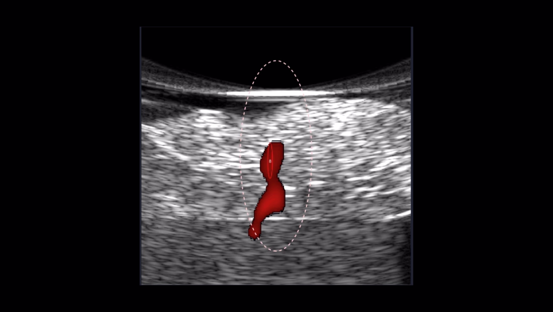 3D real-time procedure using HIFU bursts at a PRF of 1Hz, 32W total acoustic burst power, with a 90% burst duty cycle in an ex vivo chicken breast tissue. Twelve different focal exposures were applied within a volume. The TSI images represent an increase in temperature (heating) during HIFU treatment at different locations.
