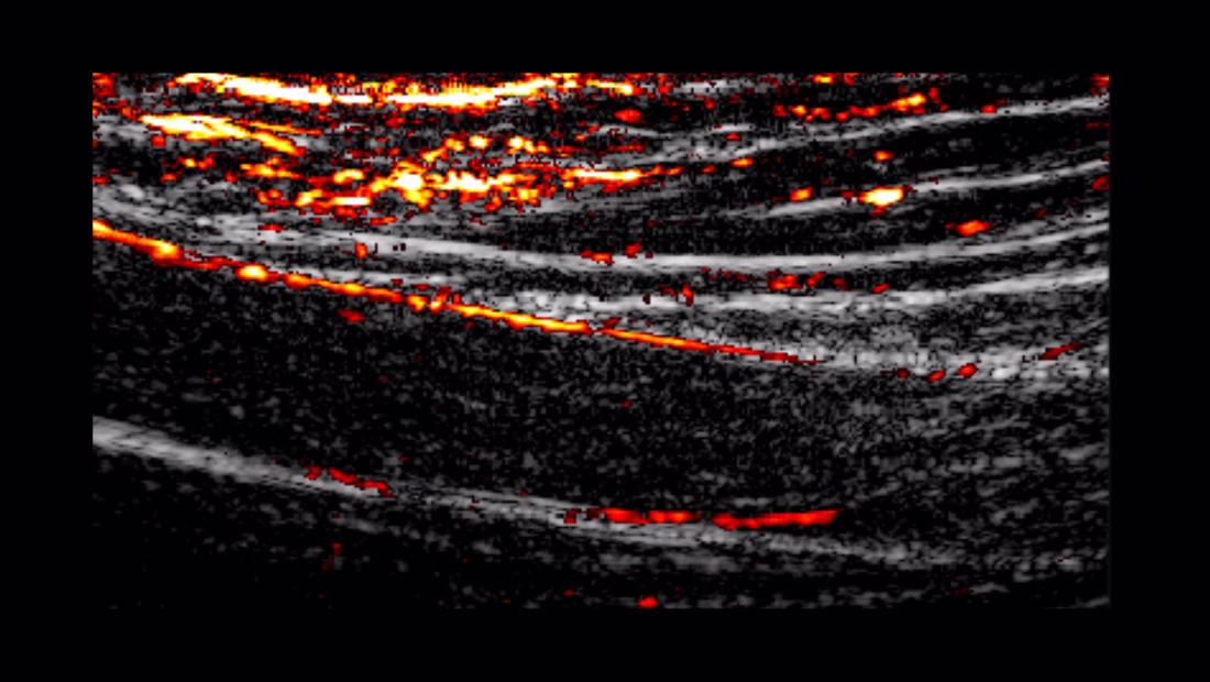 Vantage NXT supports Receive-only mode fundamental for Photoacoustics (PA) imaging. It also supports interleaving of B-mode and PAI
